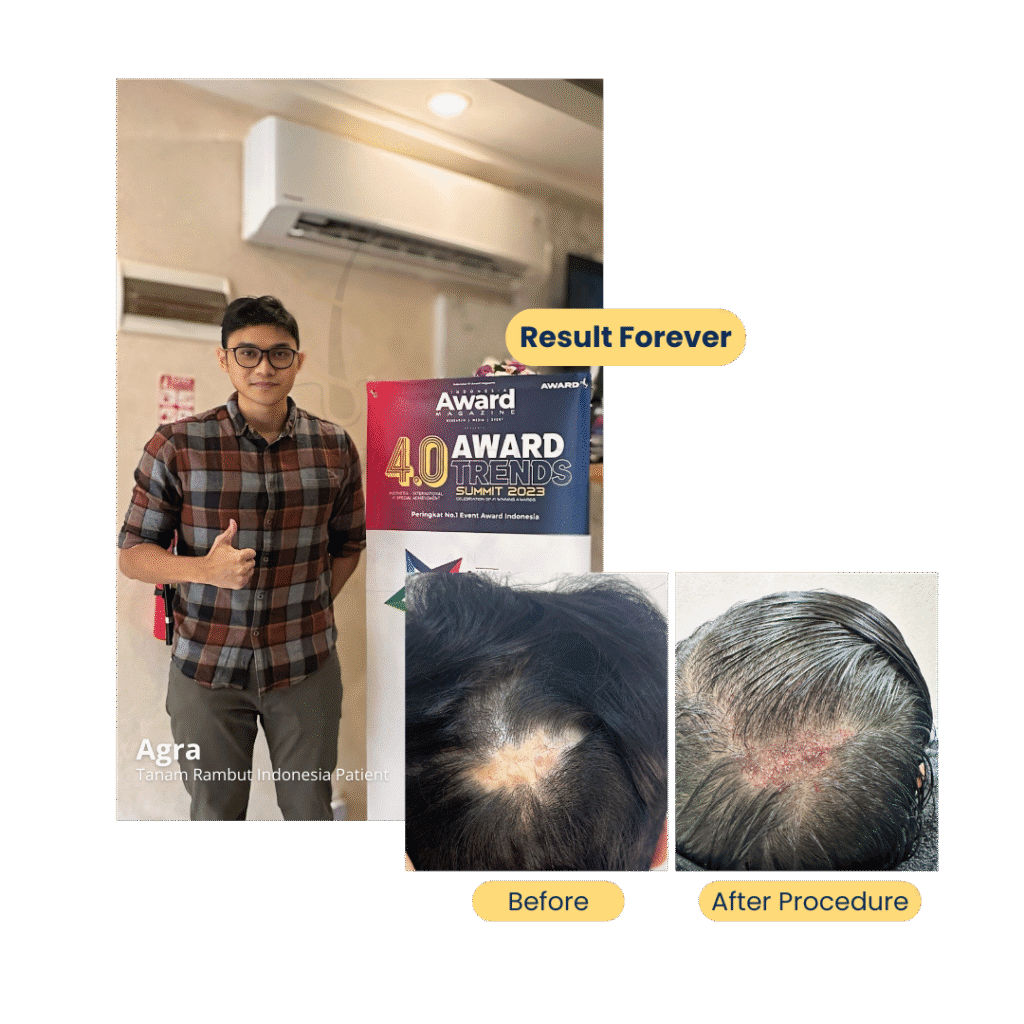 agra-pasien-di-tanam-rambut-indonesia-jakarta-selatan