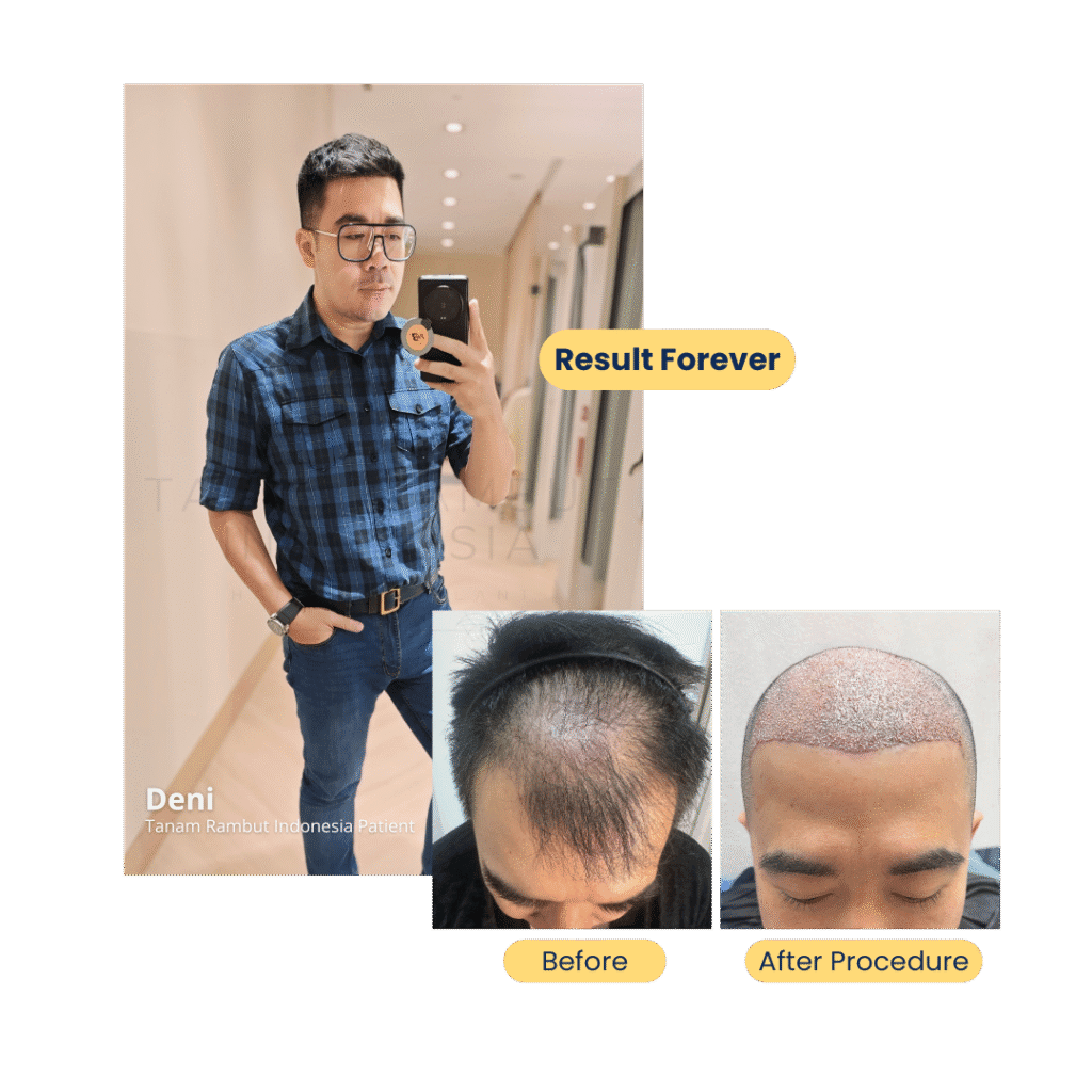 Deni – Pasien Hair Transplant di Tanam Rambut Indonesia, Jakarta Selatan, Indonesia