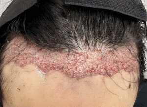 Layanan Lowering Hair Transplant di Tanam Rambut Indonesia, Jakarta Selatan