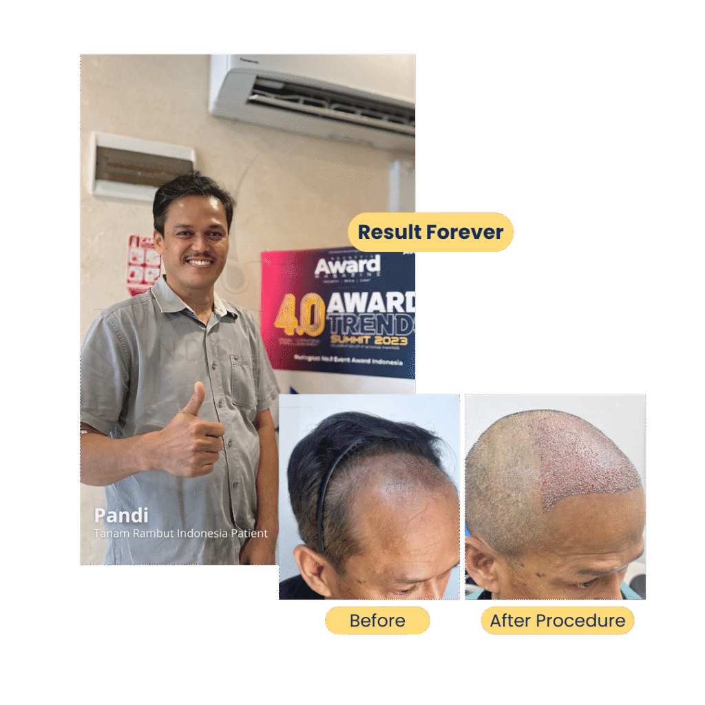 pandi-pasien-di-tanam-rambut-indonesia-jakarta-selatan
