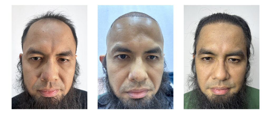 Pasien Agus – Before After Prosedur dan Setelah Beberapa Bulan di Tanam Rambut Indonesia, Jakarta Selatan
