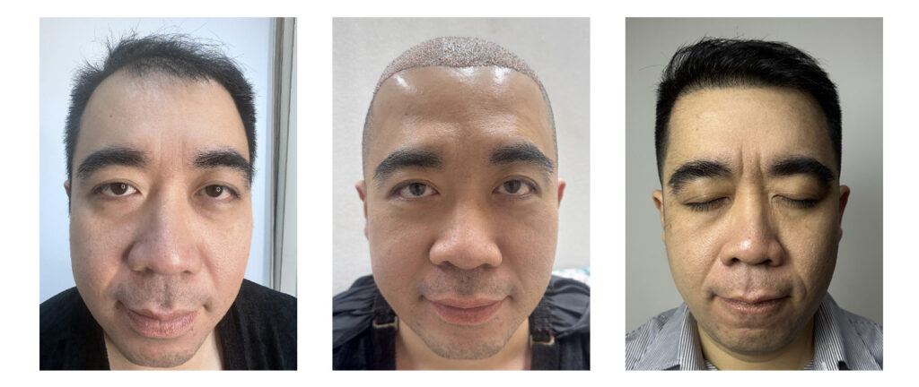 Pasien Deny – Before After Prosedur dan Setelah Beberapa Bulan di Tanam Rambut Indonesia, Jakarta Selatan