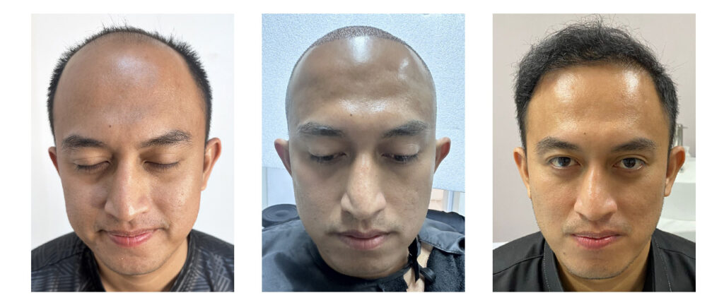 Pasien Sahril – Before After Prosedur dan Setelah Beberapa Bulan di Tanam Rambut Indonesia, Jakarta Selatan